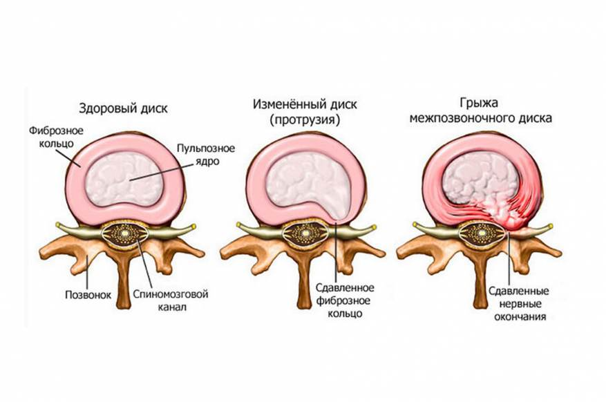 Упражнения для шеи, которые снимут боль и приведут мышцы в тонус – 1